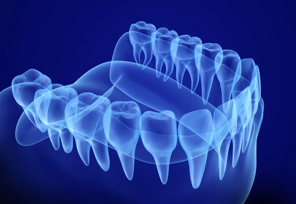 3D Treatment Planning