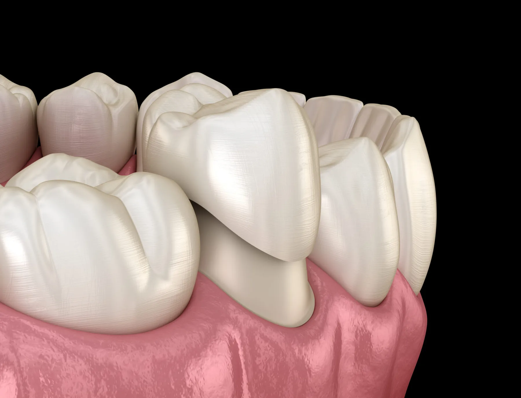 Dental Crowns