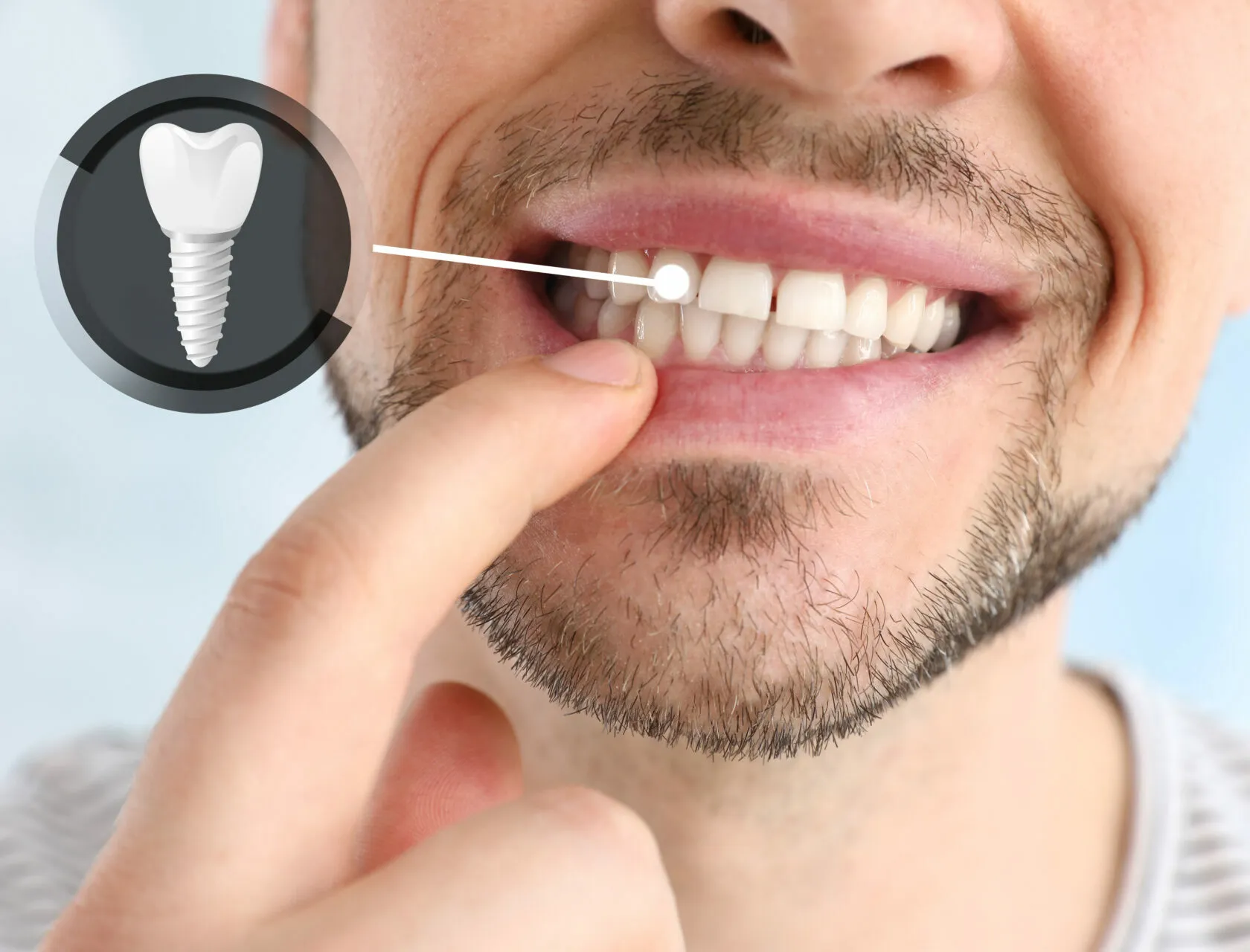 Dental Implants